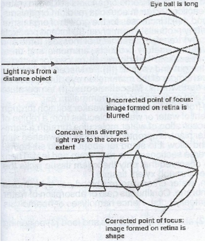 Short sightedness diagram